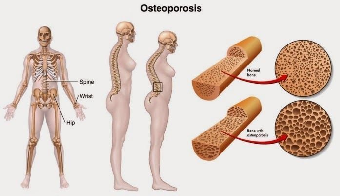 osteoporosis